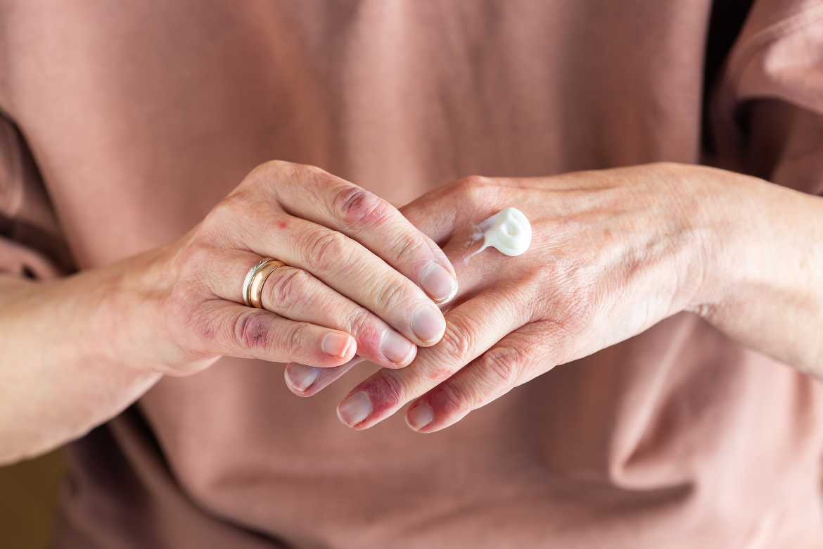 Esclerodermia: 6 cuidados diarios que deberías tener en cuenta