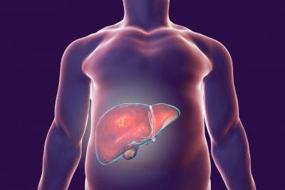 NASH, la enfermedad silenciosa de la vida moderna que afecta al hígado