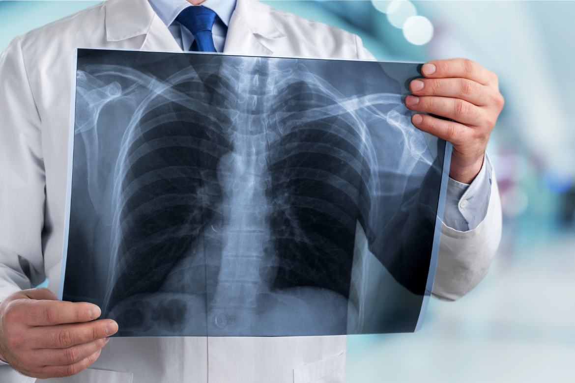 O que é fibrose pulmonar?