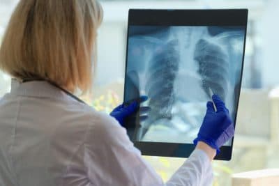 ¿Qué es la fibrosis pulmonar?