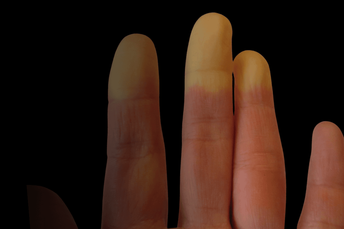 Esclerodermia: cómo afecta a los jóvenes y a los adultos