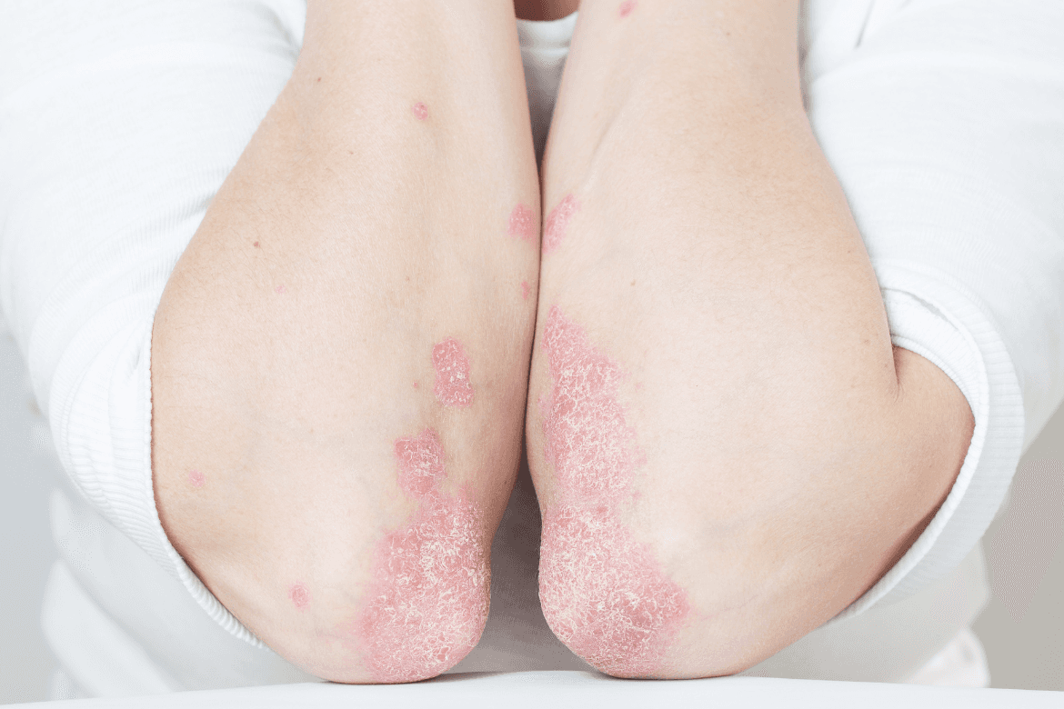 Psoriasis pustulosa generalizada: nuevo tratamiento aprobado