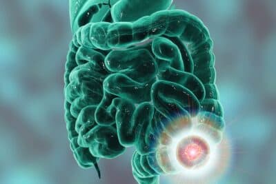 Doença inflamatória intestinal: um guia completo para pacientes e familiares