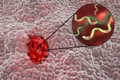 Chile desarrolla y patenta el primer probiótico para el cáncer gástrico