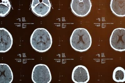 Día mundial del cerebro: 3 avances que pueden cambiar todo