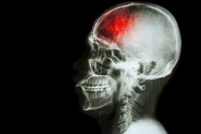 Caries y ACV: cómo la salud bucal puede aumentar el riesgo de accidente cerebrovascular