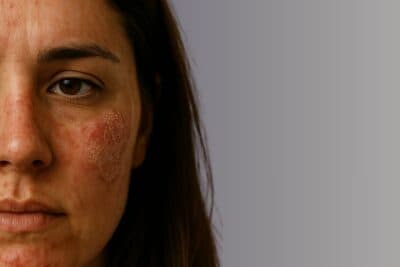 Lupus cutáneo: cómo reconocer los brotes y qué hacer a tiempo