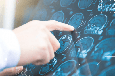 Personas con esclerosis múltiple primaria progresiva pueden participar de una investigación médica en fase III