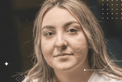 ¿Cuáles son los tratamientos disponibles para nefritis lúpica?