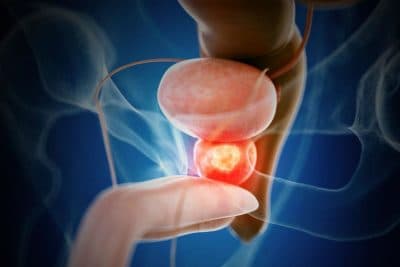 Cáncer de vejiga: de esto no se habla