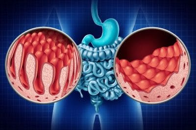 Enfermedad de Crohn: Las lesiones altas de la mucosa son más comunes de lo que se cree