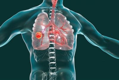 Cáncer de pulmón: mutaciones cancerígenas en la mira