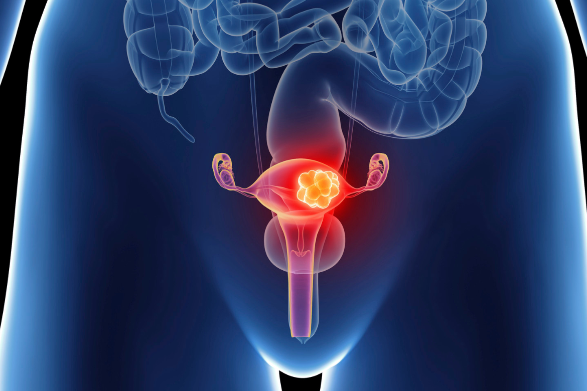 El cáncer de ovario es el séptimo tumor con mayor frecuencia en mujeres