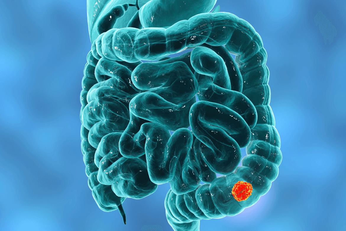 Novedoso ensayo clínico para cáncer de colon