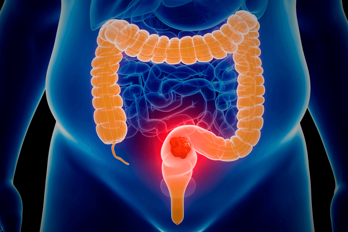 Cáncer de colon: novedosa inmunoterapia en estudio