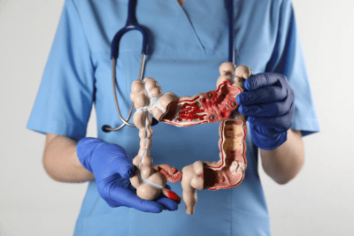Cáncer de colon: qué es la colectomía