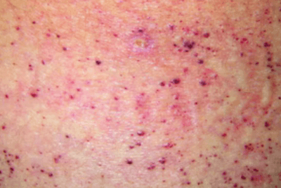 O que é a doença de Fabry