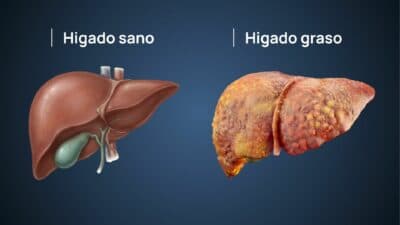 Hígado graso: causas, síntomas y cómo mejorar tu calidad de vida